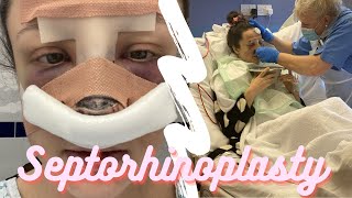 SEPTORHINOPLASTY VLOG UK MY EXPERIENCE amp RECOVERY [upl. by Othe]