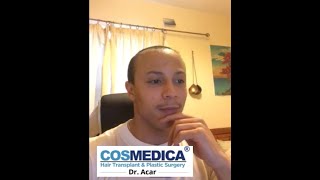 My 1 Month Cosmedica Hair Transplant Results DHI Saphire [upl. by Ponce]