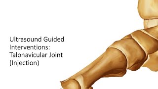 ultrasound Guided Interventions Talonavicular Joint Injection fyp sports sportsmedicine [upl. by Isadore]