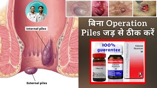 homeopathic medicine for piles piles without pain burning bleeding  piles cure without operation [upl. by Ienttirb]