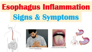 Esophagitis Esophagus Inflammation Signs amp Symptoms amp Why They Occur [upl. by Sabino]