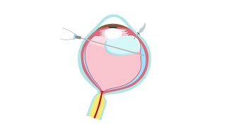 Retinal Detachment Treatment—Pars Plana Vitrectomy [upl. by Thorin932]