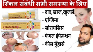 मात्र 5 दिन मे दाद खाज खुजली जड़ खत्म ।। dad khaj khujali ki dava ।। Ketoscore 6 cream uses Hindi [upl. by Atworth]