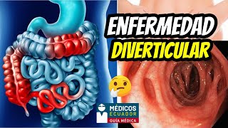 ¿Qué es la diverticulitis Causas síntomas tratamiento  Enfermedad Diverticular [upl. by Oniotna]