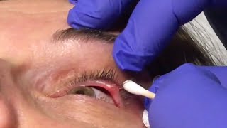 Surgeon Drains Stye On Womans Eye [upl. by Atteuqnas]