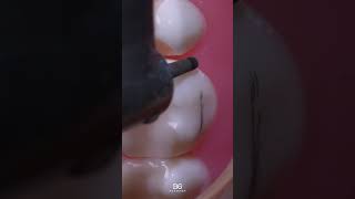 StepbyStep molar crown prep dentistry dentaleducation MolarPrep [upl. by Volkan]