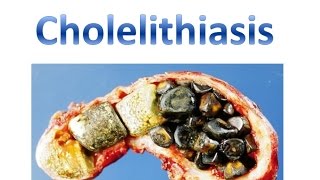 Cholelithiasis [upl. by Edik]