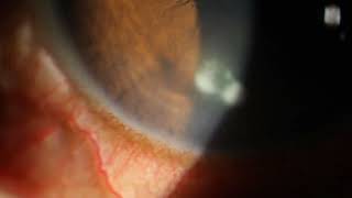 Debriding a Corneal Abrasion Recurrent Erosion with secondary Bacterial Ulcers [upl. by Hubey342]