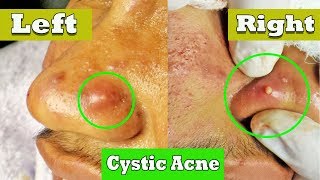 Drainage de lacné kystique sur le nez  cystic acne extraction [upl. by Dracir]