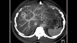 Abdomen LiverCT demonstrates a hemangioma of the liver because of the fatty infiltration10 of 10 [upl. by Eidas]