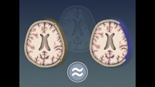 Craniectomy vs Craniotomy for Acute Subdural Hematoma  NEJM [upl. by Nahshun]