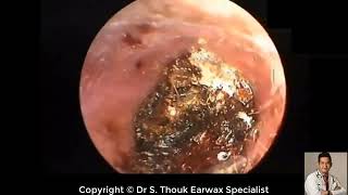 Earwax Removal Extraction Cholesteatoma Surgery Whole Video Dr Thouk Earwax Specialist [upl. by Sadnalor509]