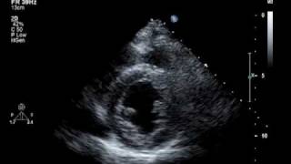 Hypokinesis Mitral Regurgitation Aortic Insufficiency [upl. by Aekahs988]