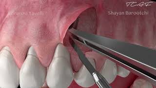 Dental Animation  The Tunneled Coronally Advanced Flap TCAF [upl. by Eecart]