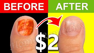 Just 2 to Cure Toenail Fungus For Good [upl. by Neahs]