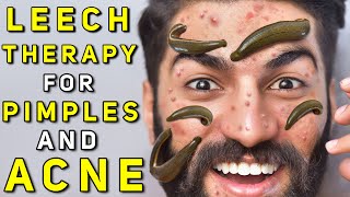 Leech Therapy for Skin Problems like Acne Pimples and Blemishes  Leech Therapy for Skin Diseases [upl. by Geordie]