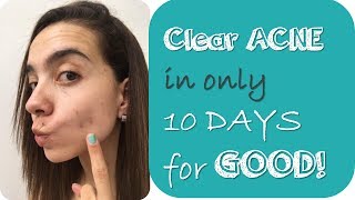 How I Cleared My Acne In 10 Days with natural ways [upl. by Yerroc314]