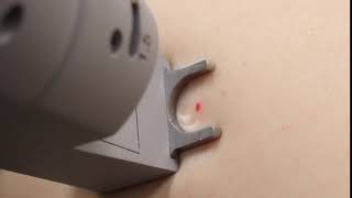 Cherry Angioma Removal [upl. by Marcelo]