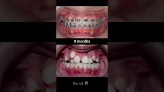 20 months Braces Transformation dentist satisfying dentalclinic dentalhealth dentalcare [upl. by Adnawed]