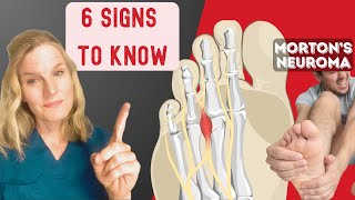 Spotting Mortons Neuroma Key signs You Shouldnt Ignore [upl. by Gibun]