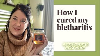 How I cured my BLEPHARITIS  chronic eye condition [upl. by Kcirdehs]