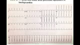 SVT supra ventricular tachycardia ekg ecg electrocadiogram Dr BenZur [upl. by Occir]