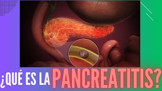 ¿Qué es la pancreatitis [upl. by Penoyer581]