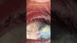 Corneal opacity after keratoplasty [upl. by Anyek535]