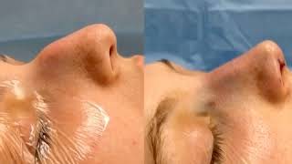 Rhinoplasty Surgery on a Female Patient performed by Andres Bustillo MD [upl. by Ylicec]