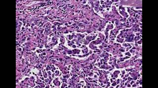 Histopathology LungDesquamative interstitial pneumonia [upl. by Gnehs323]