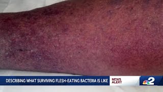 Flesheating bacteria cases in Florida double after Milton and Helene health department says [upl. by Christian]