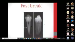 6Endodontic Mishaps partl [upl. by Anaerda]