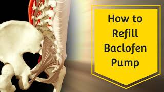 How To Refill Baclofen Pump  Tricumed Pump [upl. by Sillad998]