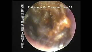 Reexamination of left ear cases not seen in a year 20231023 [upl. by Norse]