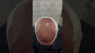 Hair Transplant Transformation 3500 Grafts [upl. by Ynaffik832]