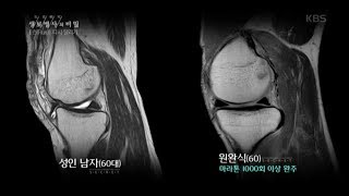 생로병사의 비밀  마라톤 풀코스를 1000번 이상 달린 사람의 무릎 상태는 20180523 [upl. by Lonier]