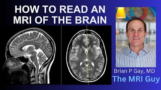 How to read an MRI of the brain  First Look MRI [upl. by Yracaz]