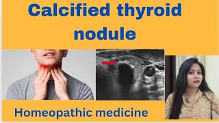 Calcified thyroid nodule treatment  Calcification in nodule symptomscauses amp homeopathic medicine [upl. by Mure763]