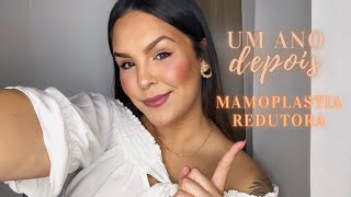 MAMOPLASTIA REDUTORA  CICATRIZ ANTES E DEPOIS ME ARREPENDI 1 ANO DEPOIS [upl. by Nednarb424]