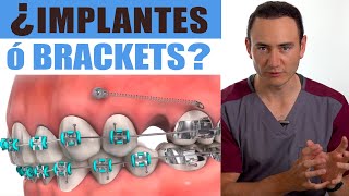 IMPLANTES o BRACKETS ¿Cuál va primero  ¡EL ORDEN SÍ IMPORTA  Ortodoncia vs Implantes [upl. by Finella]