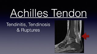 ACHILLES TENDINITIS AND RUPTURES and everything in between tendinosis  Achilles Tendon  Tears [upl. by Aniretake]