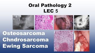 Oral Pathology 2  LEC 5  Osteosarcoma and Chndrosarcoma and Ewing Sarcoma [upl. by Lia]