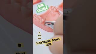 Sutures Stitches types in the mouth [upl. by Bouley412]