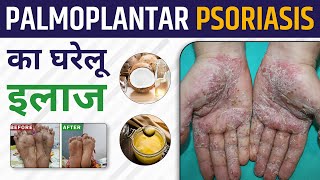 घर पर ही पाएं Palmoplantar Psoriasis का सही इलाज  Best Way to Heal Palmoplantar Psoriasis at Home [upl. by Eula62]