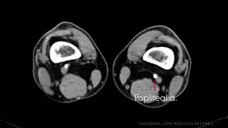 Lower Limb arterial anatomy  CT scan [upl. by Skinner]