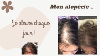 Mon désespoir ALOPECIE ANDROGENETIQUE ⭐ [upl. by Aennyl]