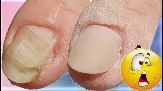 DEFORMIERTER Nagel durch VERLETZUNG😱😱Rekonstruktion eines Nagels nagelverletzung [upl. by Dorcus]