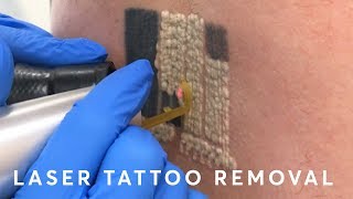 Laser Tattoo Removal PAIN RESULTS amp PROCEDURE [upl. by Reste]