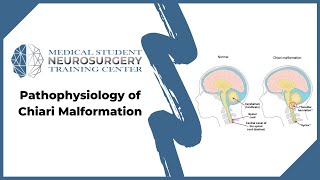 Pathophysiology of Chiari Malformation [upl. by Pansy]