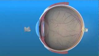 Intraocular Lens IOL [upl. by Halvaard]